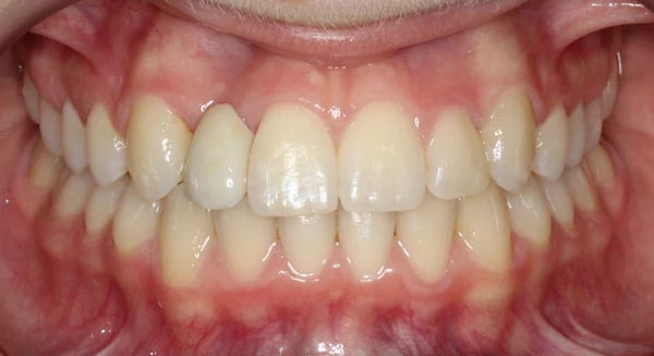 Smile after orthodontic treatment
